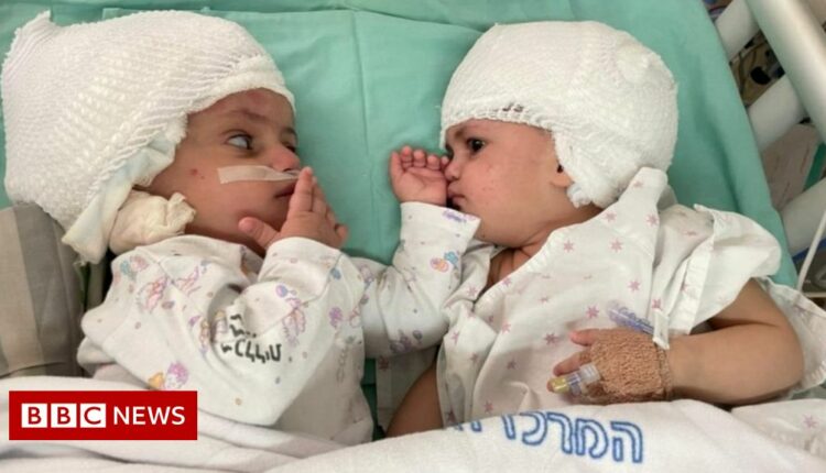 Twins conjoined at head separated after rare surgery in Israel