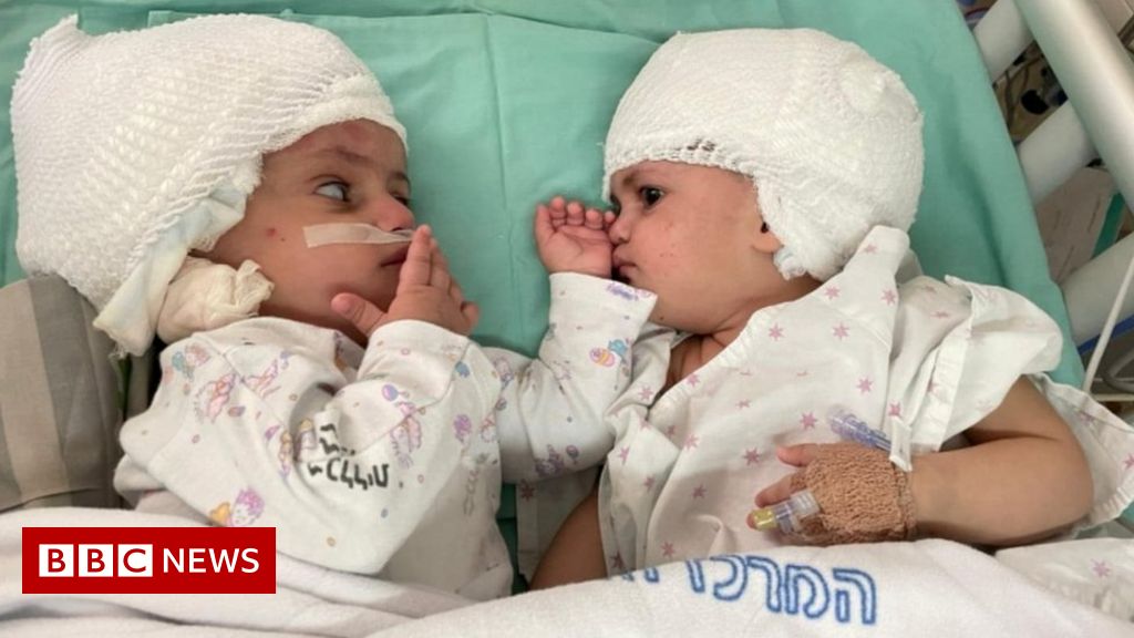 Twins conjoined at head separated after rare surgery in Israel